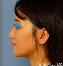 Rhinoplasty After Photo by William Lao, MD; New York, NY - Case 33773