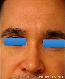 Rhinoplasty After Photo by William Lao, MD; New York, NY - Case 33774