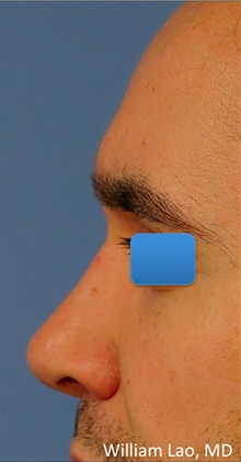 Rhinoplasty After Photo by William Lao, MD; New York, NY - Case 33774