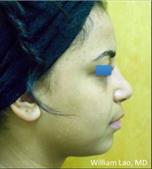 Rhinoplasty After Photo by William Lao, MD; New York, NY - Case 33775