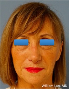 Rhinoplasty After Photo by William Lao, MD; New York, NY - Case 33776
