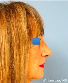 Rhinoplasty After Photo by William Lao, MD; New York, NY - Case 33776
