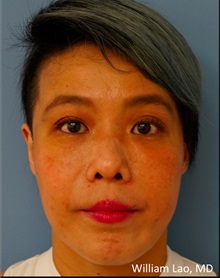 Eyelid Surgery After Photo by William Lao, MD; New York, NY - Case 33783