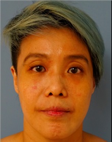 Eyelid Surgery Before Photo by William Lao, MD; New York, NY - Case 33783