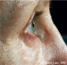 Eyelid Surgery After Photo by William Lao, MD; New York, NY - Case 33784
