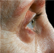 Eyelid Surgery Before Photo by William Lao, MD; New York, NY - Case 33784