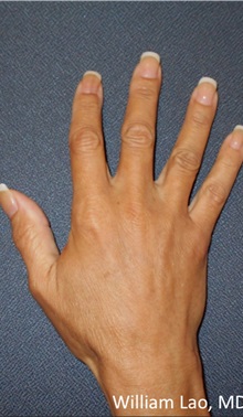 Hand Surgery After Photo by William Lao, MD; New York, NY - Case 33785