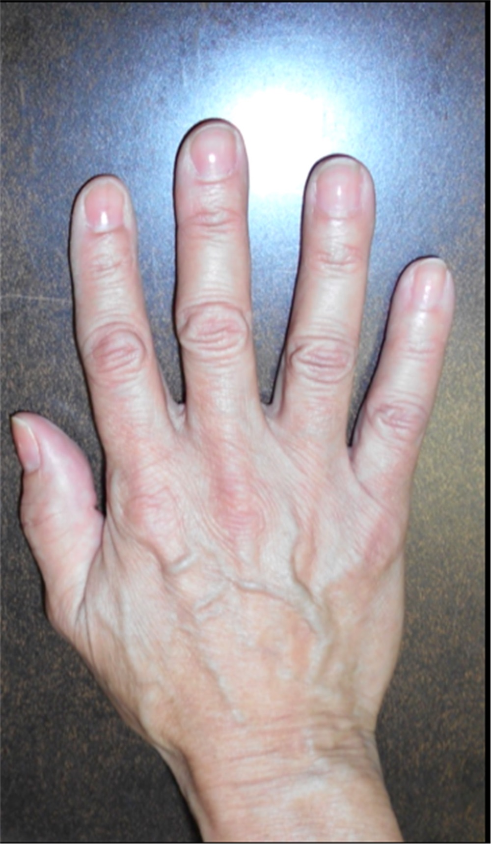 Plastic Surgery Associates offers treatment to help patients regain hand  function