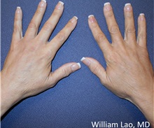 Hand Surgery After Photo by William Lao, MD; New York, NY - Case 33785