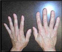 Hand Surgery Before Photo by William Lao, MD; New York, NY - Case 33785