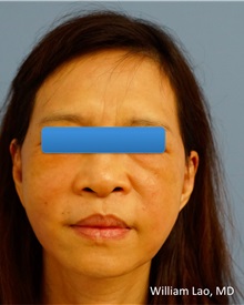 Facelift After Photo by William Lao, MD; New York, NY - Case 33786
