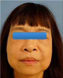 Facelift Before Photo by William Lao, MD; New York, NY - Case 33786