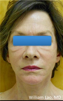 Facelift After Photo by William Lao, MD; New York, NY - Case 33787