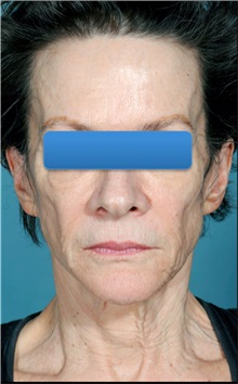 Facelift Before Photo by William Lao, MD; New York, NY - Case 33787
