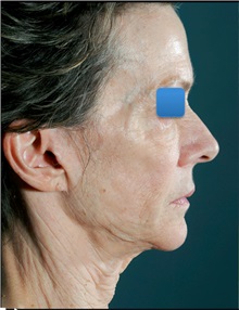 Facelift Before Photo by William Lao, MD; New York, NY - Case 33787