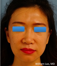 Facelift After Photo by William Lao, MD; New York, NY - Case 33788