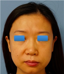 Facelift Before Photo by William Lao, MD; New York, NY - Case 33788