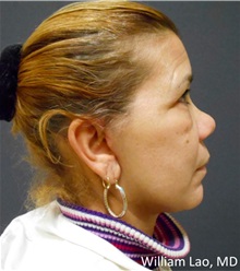 Facelift After Photo by William Lao, MD; New York, NY - Case 33789