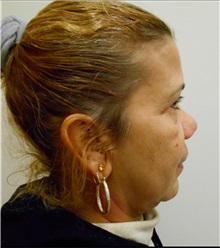 Facelift Before Photo by William Lao, MD; New York, NY - Case 33789