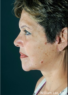 Facelift After Photo by William Lao, MD; New York, NY - Case 33790