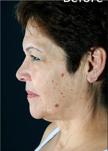 Facelift Before Photo by William Lao, MD; New York, NY - Case 33790