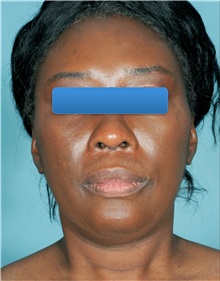 Liposuction Before Photo by William Lao, MD; New York, NY - Case 33792