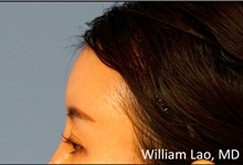 Facial Implants After Photo by William Lao, MD; New York, NY - Case 33794