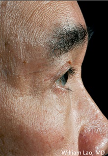 Eyelid Ptosis Repair After Photo by William Lao, MD; New York, NY - Case 33796