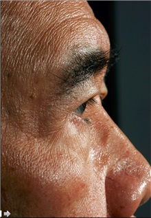 Eyelid Ptosis Repair Before Photo by William Lao, MD; New York, NY - Case 33796