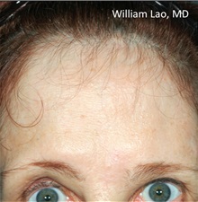 Brow Lift After Photo by William Lao, MD; New York, NY - Case 33797