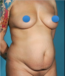 Tummy Tuck Before Photo by William Lao, MD; New York, NY - Case 33798