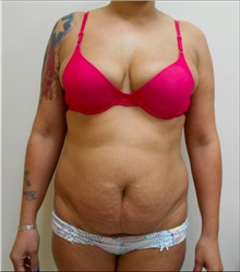 Tummy Tuck Before Photo by William Lao, MD; New York, NY - Case 33799