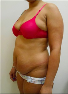 Tummy Tuck Before Photo by William Lao, MD; New York, NY - Case 33799