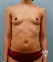 Breast Augmentation Before Photo by William Lao, MD; New York, NY - Case 33800