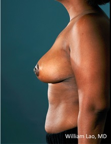 Breast Reduction After Photo by William Lao, MD; New York, NY - Case 33806
