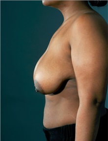 Breast Reduction Before Photo by William Lao, MD; New York, NY - Case 33806
