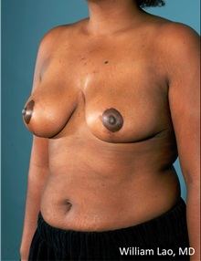 Breast Reduction After Photo by William Lao, MD; New York, NY - Case 33806