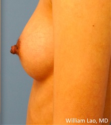 Breast Reconstruction After Photo by William Lao, MD; New York, NY - Case 33807