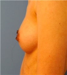 Breast Reconstruction Before Photo by William Lao, MD; New York, NY - Case 33807