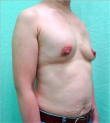 Breast Implant Removal Before Photo by William Lao, MD; New York, NY - Case 33809