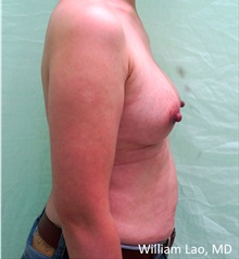 Breast Implant Removal After Photo by William Lao, MD; New York, NY - Case 33809