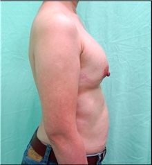 Breast Implant Removal Before Photo by William Lao, MD; New York, NY - Case 33809