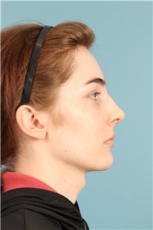 Rhinoplasty After Photo by Jay Xue, MD; Grapevine, TX - Case 50935