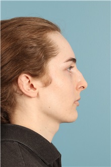 Rhinoplasty Before Photo by Jay Xue, MD; Grapevine, TX - Case 50935