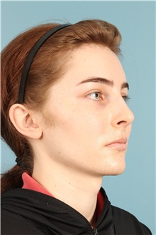 Rhinoplasty After Photo by Jay Xue, MD; Grapevine, TX - Case 50935