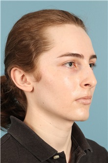 Rhinoplasty Before Photo by Jay Xue, MD; Grapevine, TX - Case 50935