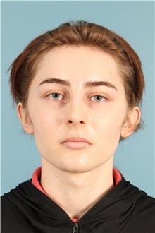 Rhinoplasty After Photo by Jay Xue, MD; Grapevine, TX - Case 50935