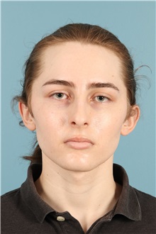 Rhinoplasty Before Photo by Jay Xue, MD; Grapevine, TX - Case 50935