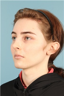 Rhinoplasty After Photo by Jay Xue, MD; Grapevine, TX - Case 50935