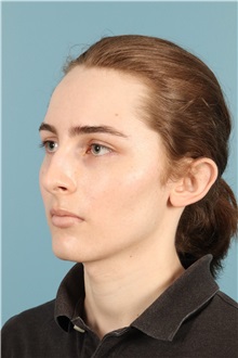 Rhinoplasty Before Photo by Jay Xue, MD; Grapevine, TX - Case 50935